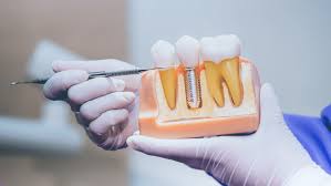 How To Get Dental Implants: Step-By-Step Guide